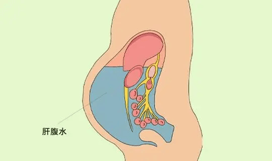二,肿瘤晚期为什么会出现腹水症?